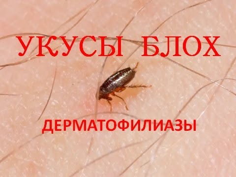 Блохи. Укусы блох (Дерматофилиазы)