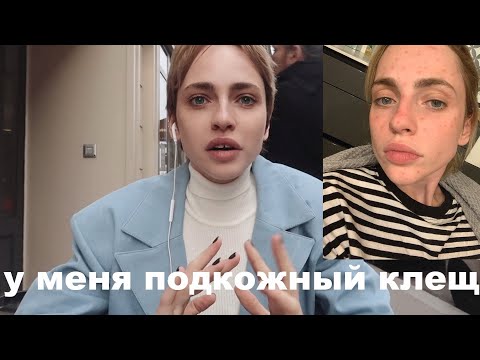 КАК Я ВЫЛЕЧИЛА КОЖУ? | подкожный клещ | модельная жесть