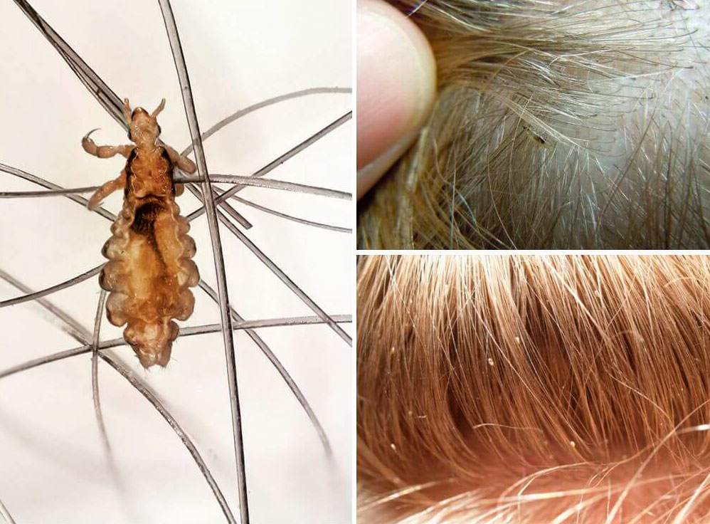 Сколько могут находится на волосах гниды