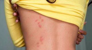 Кто кусает ночью в постели кроме клопов