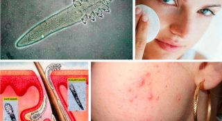 Лечение демодекоза у человека