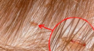 Как выглядят вши и гниды