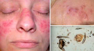 Подкожный клещ на лице